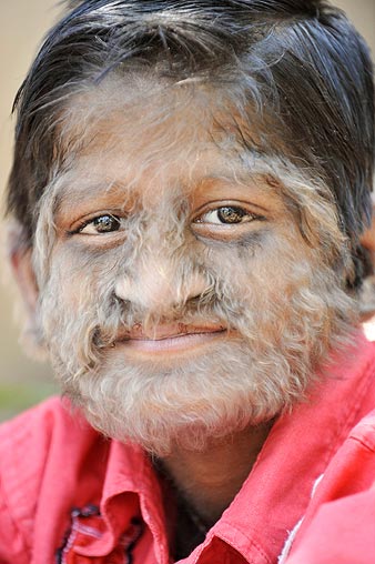 Werewolf Syndrome